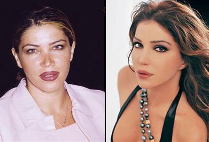 النجمات العرب بين عمليات التجميل والمبالغة